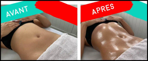 Technique de drainage lymphatique ventouses sur les jambes