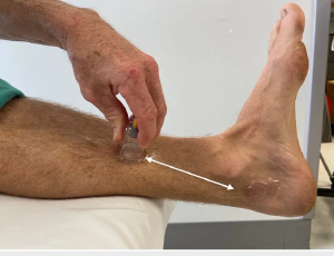 Therapie Par Ventouses Sur La Douleur Du Syndrome De Stress Tibial Medial 300x230