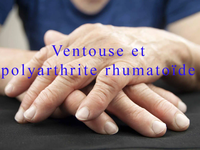 Ventouse Et Polyarthrite Rhumatoide 1024x683