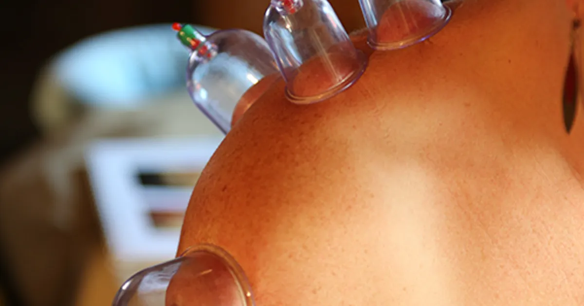 Ventouse appliquée sur l'épaule pour soulager une tendinite de la coiffe des rotateurs