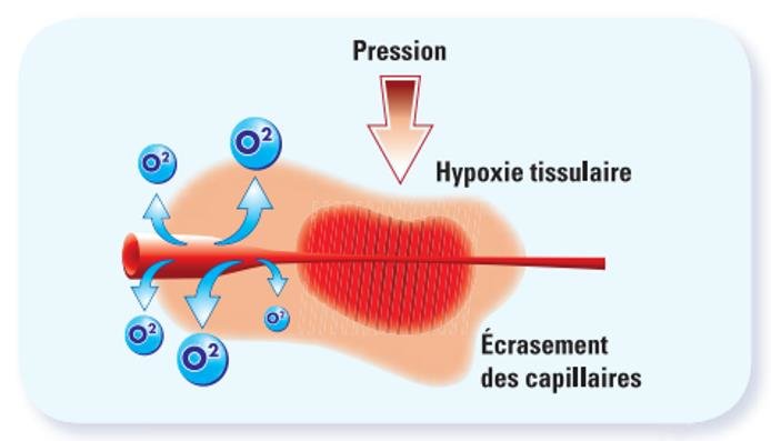 compression ischémique
