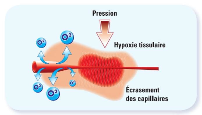 compression ischémique